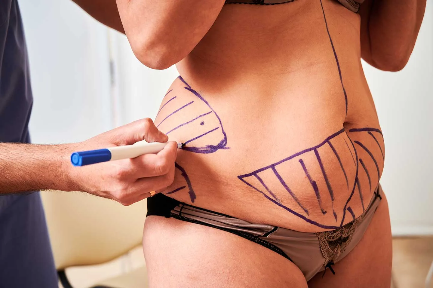 Tummy tuck and breast lift cost in Mexico City — Argaman Plastic Surgeries Mexico